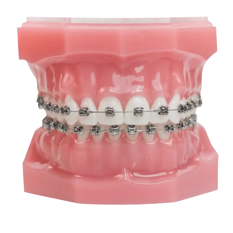 metal braces