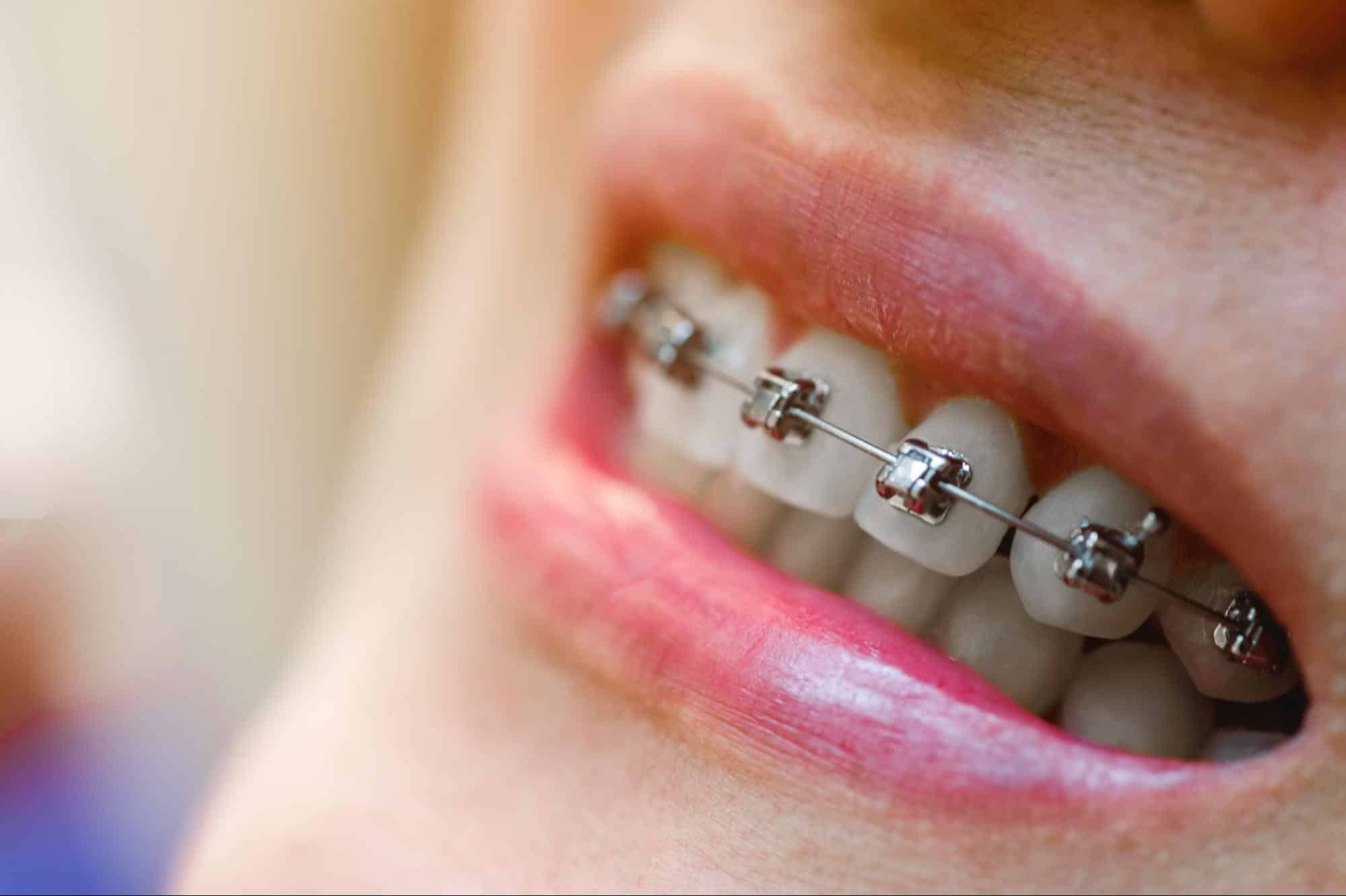 Why We Recommend Damon Braces